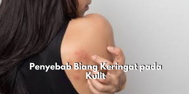 Kurangnya Kebersihan Kulit Menjadi Salah Satu Penyebab Biang Keringat, Cek 5 Penyebab Lainnya Disini!