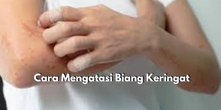 Ternyata Mudah Lho! Gunakan 6 Cara Ini untuk Mengatasi Biang Keringat Pada Kulit, Salah Satunya Bersihkan Kulit Dengan Lembut