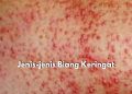 Ketahui dari Sekarang! Ada 4 Jenis Biang Keringat yang Berbahaya Bagi Kesehatan Kulit, Mulai dari Miliaria Kristalina hingga Miliaria Pustulosa