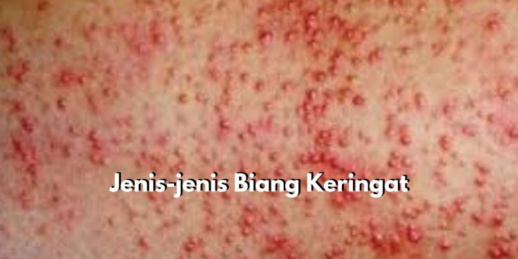 Ketahui dari Sekarang! Ada 4 Jenis Biang Keringat yang Berbahaya Bagi Kesehatan Kulit, Mulai dari Miliaria Kristalina hingga Miliaria Pustulosa