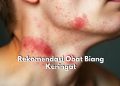 Penderita Biang Keringat Wajib Tahu! Ini Dia 7 Pilihan Obat untuk Atasinya, Nomor 1 Caladine Lotion