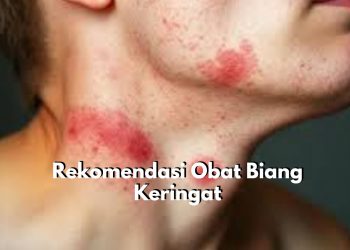 Penderita Biang Keringat Wajib Tahu! Ini Dia 7 Pilihan Obat untuk Atasinya, Nomor 1 Caladine Lotion
