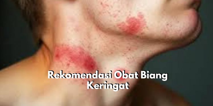 Penderita Biang Keringat Wajib Tahu! Ini Dia 7 Pilihan Obat untuk Atasinya, Nomor 1 Caladine Lotion