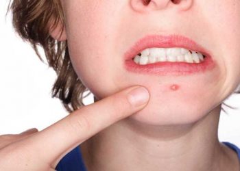 Cara Mudah Hilangkan Bekas Jerawat, Cek 8 Bahan Alami Ini