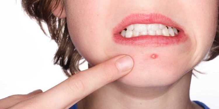 Cara Mudah Hilangkan Bekas Jerawat, Cek 8 Bahan Alami Ini