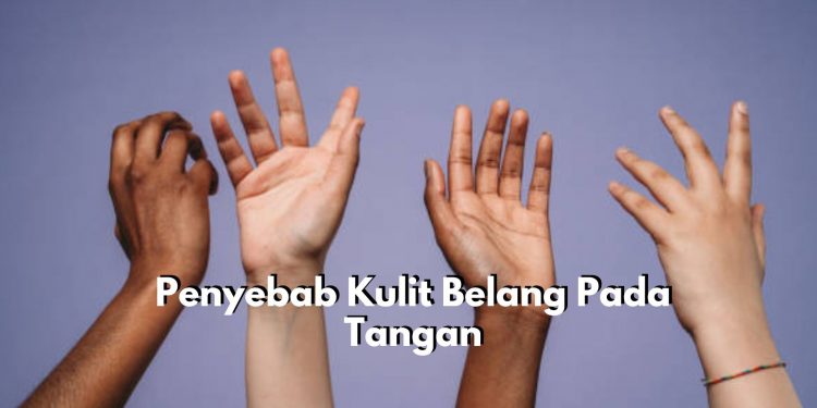 Bukan Hanya Karena Paparan Sinar Matahari! Inilah Sederet Penyebab Kulit Belang Pada Tangan