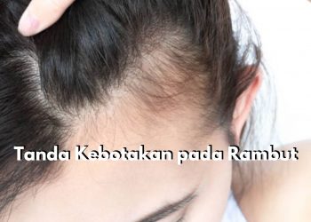 Waspada! 7 Tanda Ini dapat Memicu Kebotakan pada Rambut, Apa Saja?