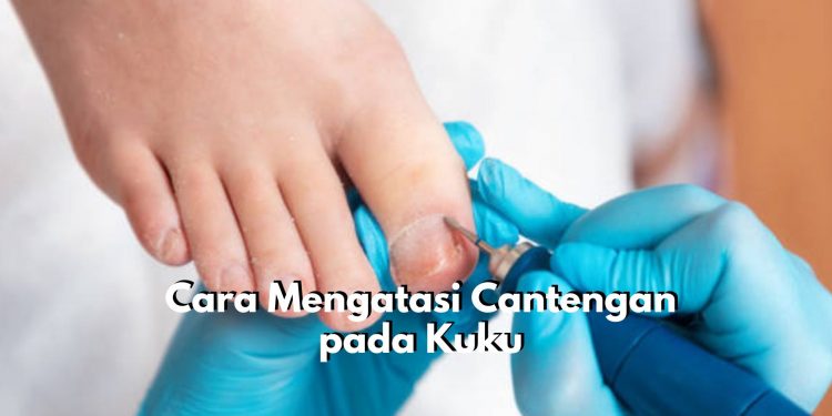 Sering Alami Kuku Cantengan? Coba Atasi dengan 5 Cara Ini, Salah Satunya Gunakan Obat Antiseptik atau Salep Antibiotik