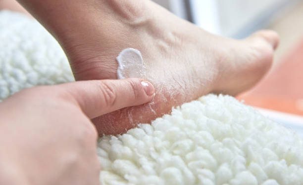 Tumit Kakimu Pecah-pecah? Ternyata Ini 5 Penyebab Utamanya, Tak Terkecuali Karena Kulit Kering