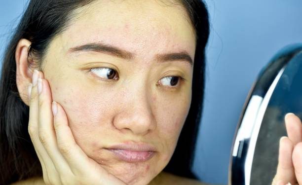 Wajib Tahu! Ternyata Ini 5 Ciri-ciri Kulit Kusam, Salah Satunya dari Penumpukan Sel Kulit Mati