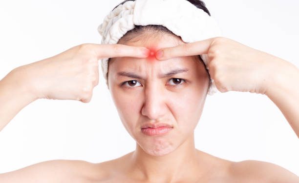 Ternyata Ini Segudang Penyebab yang Bisa Memicu Timbulnya Jerawat Batu di Wajah, Utamanya Perubahan Hormon