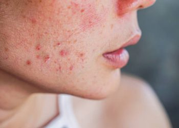 Ada 5 Bahan Alami yang Bisa Kamu Coba untuk Atasi Masalah Beruntusan di Kulit Wajah, Cek Sekarang Juga!