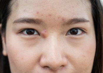 Benjolan Besar di Wajah Jadi Ciri-ciri Utama Jerawat Batu, Intip 4 Ciri Lainnya!