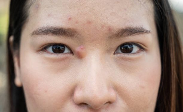 Benjolan Besar di Wajah Jadi Ciri-ciri Utama Jerawat Batu, Intip 4 Ciri Lainnya!