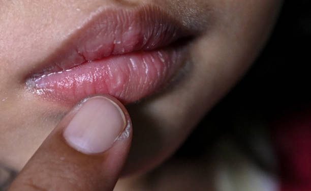 Kenali Penyebab Sariawan yang Terjadi pada Anak, Tak Terkecuali Kekurangan Nutrisi Tertentu