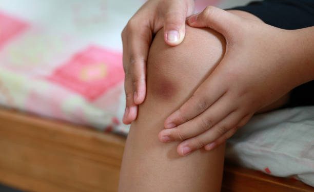 Trauma atau Cedera Ringan dapat Jadi Pemicu Utama Pada Memar, Cek Beberapa Penyebab Lainnya Disini!