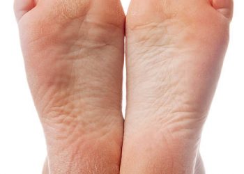 Ingin Tumit Kaki Tetap Mulus Tanpa Pecah-pecah? Ini Beberapa Cara yang Bisa Kamu Terapkan, Cek Sekarang Juga!