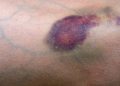 Cek Fakta dari Beberapa Jenis Warna Memar di Tubuh, Ada Warna Merah hingga Warna Keungguan