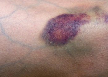 Cek Fakta dari Beberapa Jenis Warna Memar di Tubuh, Ada Warna Merah hingga Warna Keungguan