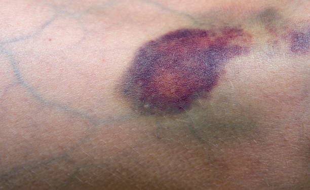 Cek Fakta dari Beberapa Jenis Warna Memar di Tubuh, Ada Warna Merah hingga Warna Keungguan