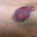 Cek Fakta dari Beberapa Jenis Warna Memar di Tubuh, Ada Warna Merah hingga Warna Keungguan