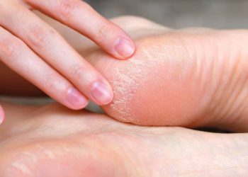 Ini Dia 5 Rekomendasi Obat Alami untuk Mengatasi Tumit Kaki Pecah-pecah, Apa Saja?