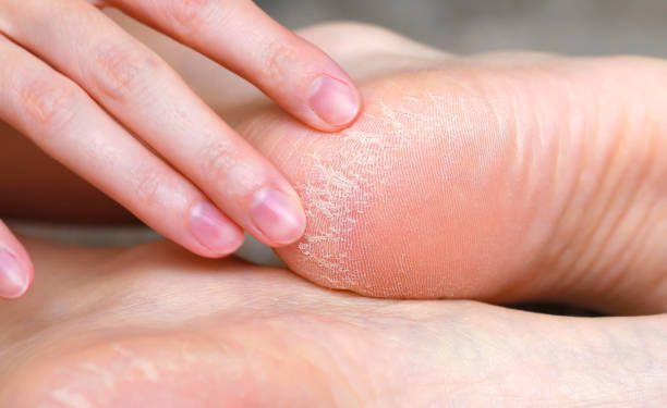 Ini Dia 5 Rekomendasi Obat Alami untuk Mengatasi Tumit Kaki Pecah-pecah, Apa Saja?