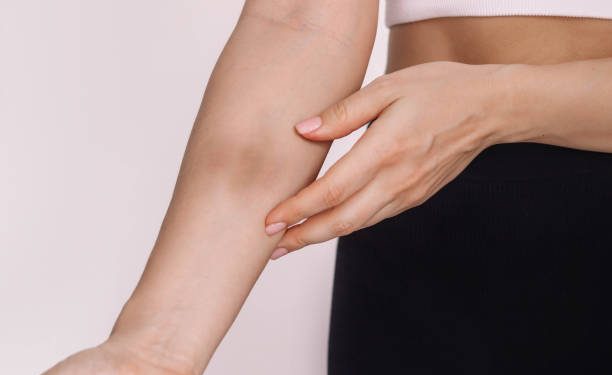 Sering Alami Memar Tanpa Sebab? Ternyata Ini 6 Penyebabnya, Yuk Mari Dilihat!