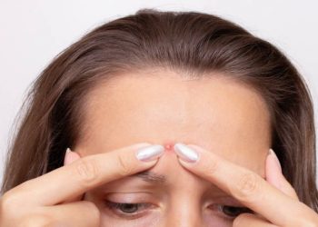 Rutin Bersihkan Wajah dengan Teratur hingga Berolahraga di Pecaya Ampuh Cegah Jerawat Batu, Cek Selengkapnya Disini!