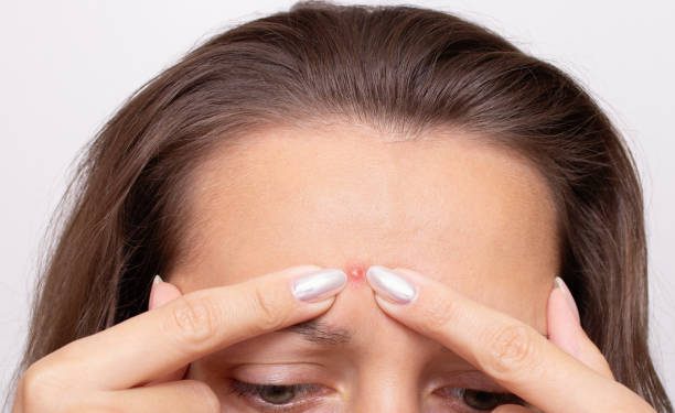 Rutin Bersihkan Wajah dengan Teratur hingga Berolahraga di Pecaya Ampuh Cegah Jerawat Batu, Cek Selengkapnya Disini!