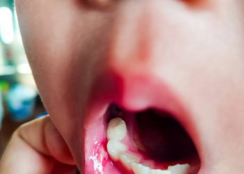Bunda Wajib Tahu! Berikut Ini Ada 8 Cara yang Bisa Dicoba untuk Mencegah Sariawan pada Anak