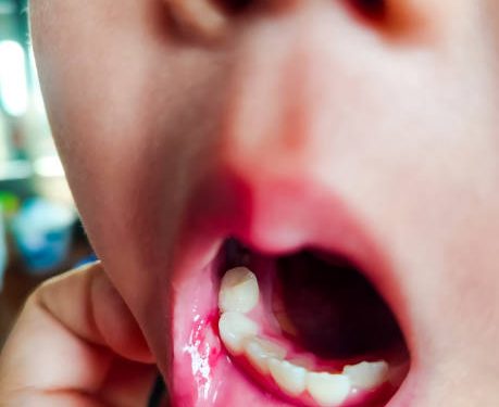 Bunda Wajib Tahu! Berikut Ini Ada 8 Cara yang Bisa Dicoba untuk Mencegah Sariawan pada Anak