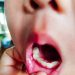 Bunda Wajib Tahu! Berikut Ini Ada 8 Cara yang Bisa Dicoba untuk Mencegah Sariawan pada Anak