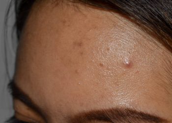 Susah Hilangkan Jerawat Batu? Coba Lakukan Beberapa Cara Ini, Terbukti Ampuh!