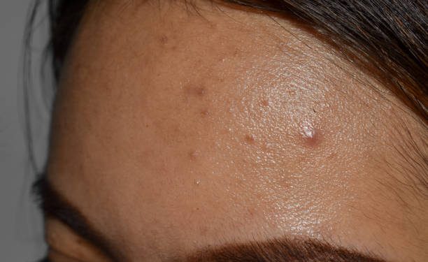 Susah Hilangkan Jerawat Batu? Coba Lakukan Beberapa Cara Ini, Terbukti Ampuh!