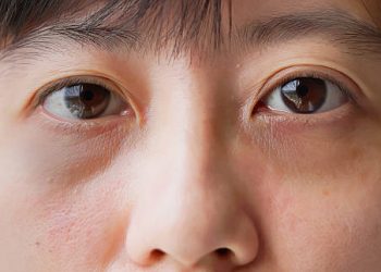 Kurang Tidur Bisa Memicu Mata Panda, Cek Beberapa Penyebab Lainnya