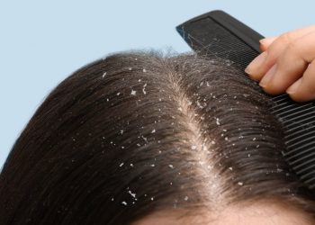 Rambut Gatal Karena Ketombe? Cek Cara Mengatasi di Sini, Cukup Pakai Bahan Alami Ini