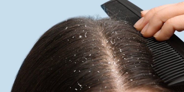 Rambut Gatal Karena Ketombe? Cek Cara Mengatasi di Sini, Cukup Pakai Bahan Alami Ini
