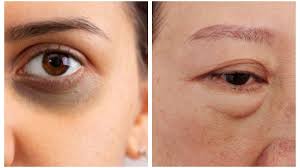 Ternyata Kantung Mata dan Mata Panda Itu Tidak Sama Lho, Simak Disini Perbedaanya!