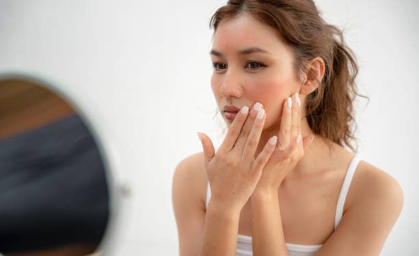 Ternyata Ini 5 Ciri Kulit Sensitif, Apakah Kulitmu Termasuk?