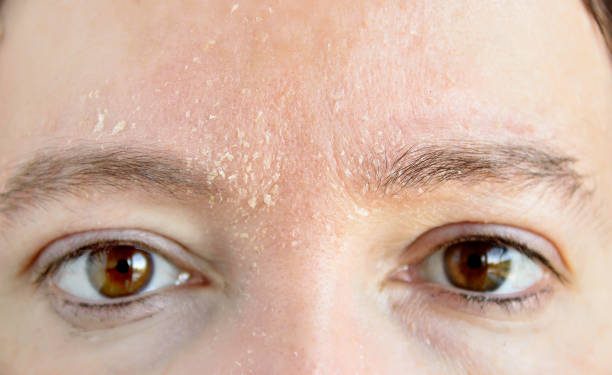 Jangan Salah! Terapkan Beberapa Tips Ini untuk Memilih Produk Kosmetik Pada Kulit Kering