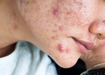 Jerawat Batu Sering Muncul di Wajah? Ketahui Penyebabnya dari Sekarang!