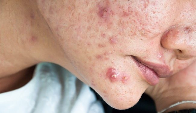 Jerawat Batu Sering Muncul di Wajah? Ketahui Penyebabnya dari Sekarang!