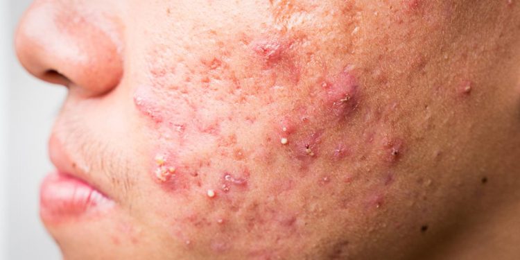 5 Cara Jitu Hilangkan Jerawat Batu di Wajah, di Jamin Ampuh!