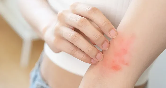 Sering Alami Alergi pada Kulit? Ini 5 Cara untuk Mengatasinya