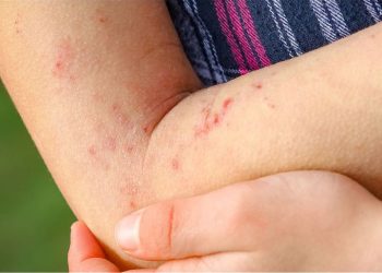 Wajib Tahu! Ini Ragam Jenis Alergi pada Kulit, Paling Umum Dermatitis Kontak