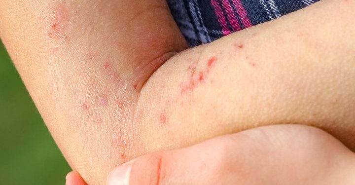 Wajib Tahu! Ini Ragam Jenis Alergi pada Kulit, Paling Umum Dermatitis Kontak