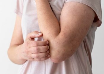 Yuk, Kenali Macam-macam Alergi dan Penyebabnya, Ada yang Berasal dari Makanan Lho!