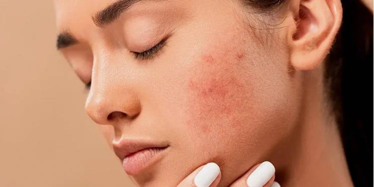 Ini 5 Ciri Kulit Sensitif yang Perlu Diketahui, Salah Satunya Rentan Terhadap Iritasi Lingkungan