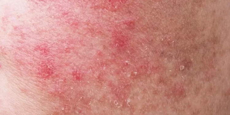 Kulitmu Sensitif? Lakukan 5 Cara Ini untuk Merawatnya, Selalu Gunakan Pelembab